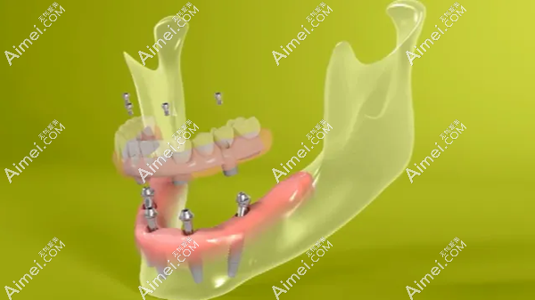 種植體數(shù)量對中諾口腔醫(yī)院全口種植牙費用的影響