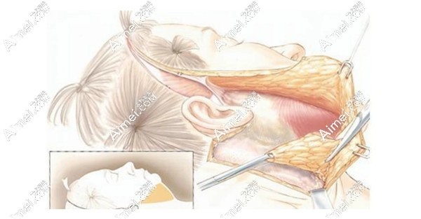 杨大平做拉皮手术好 杨大平做拉皮手术好