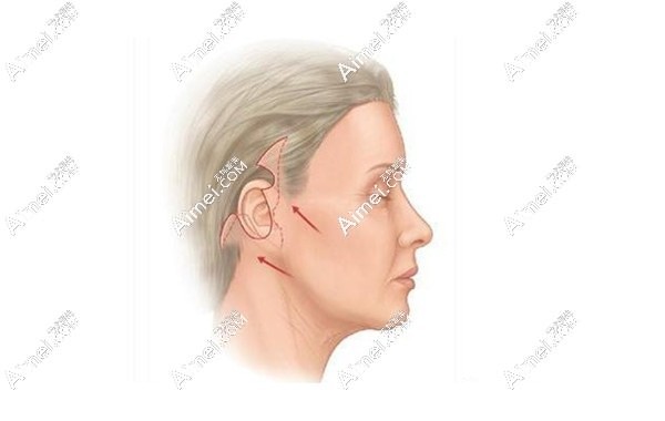 杜太超面部提升手术优势 杜太超面部提升手术优势