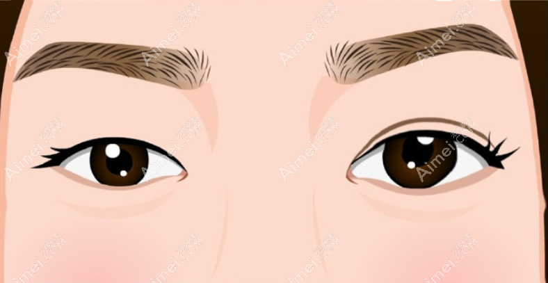 成都地区牛的双眼皮修复医生及对应医院的介绍 成都地区牛的双眼皮修复医生及对应医院的介绍
