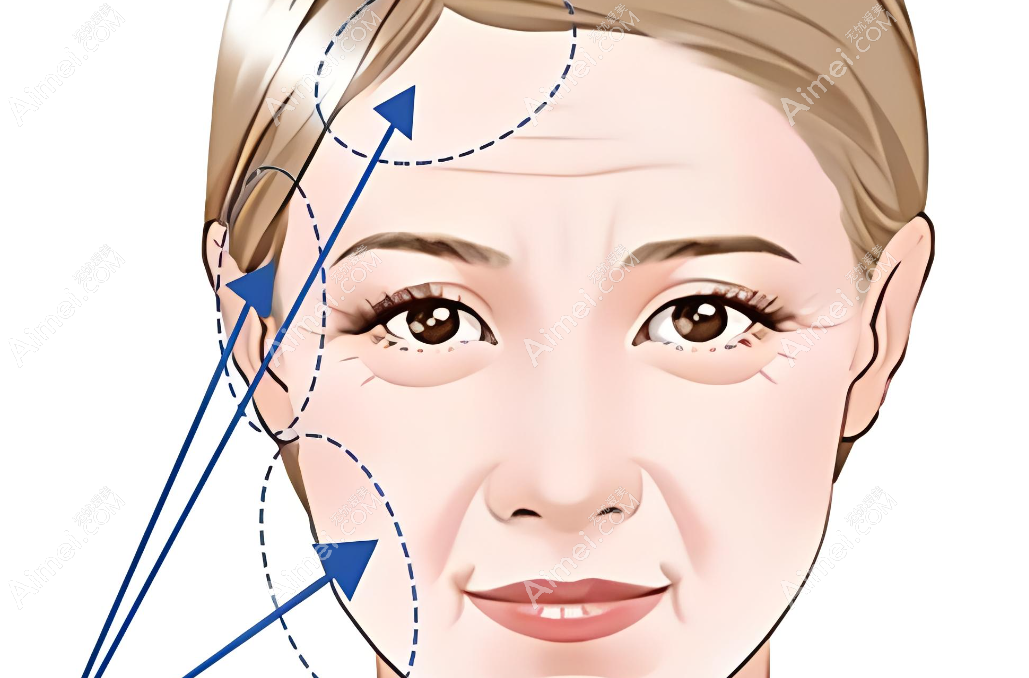 這是拉皮手術(shù)示意圖