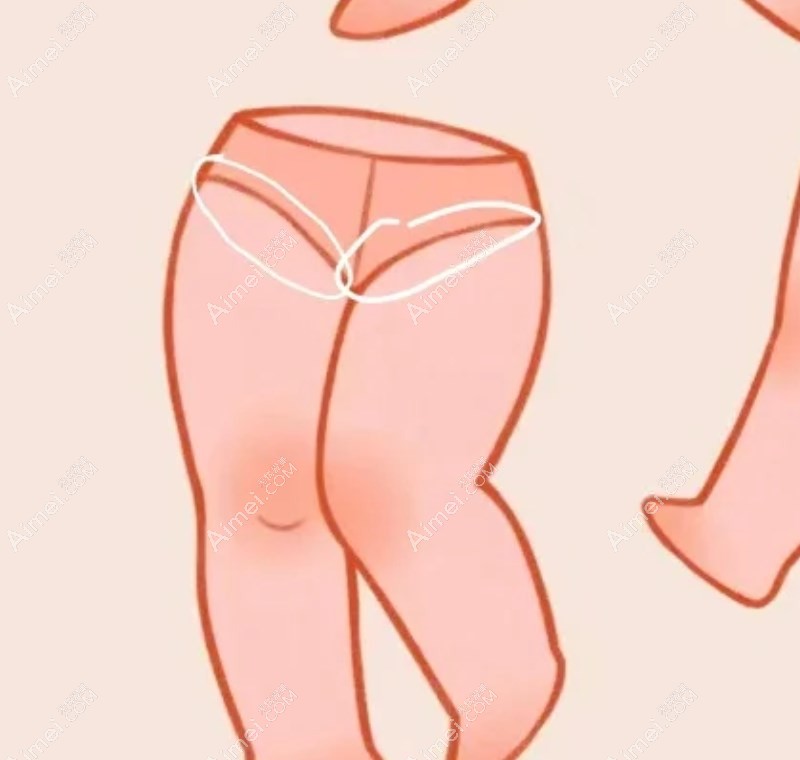 沈陽杏林整形醫(yī)院吸脂