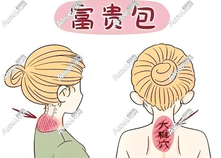 黄学峰一针去除富贵包价格