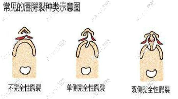 高尚余文林做唇裂修复价格 高尚余文林做唇裂修复价格