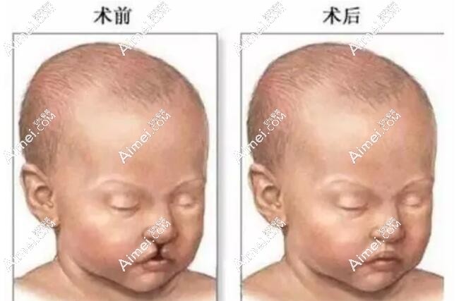 高尚余文林做唇裂修复能达到自然无疤 高尚余文林做唇裂修复能达到自然无疤