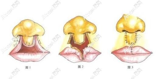 唇裂顾客在治疗过程中会遇到心理压力 唇裂顾客在治疗过程中会遇到心理压力