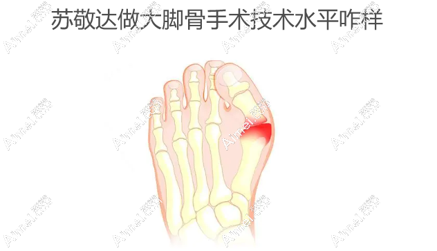 苏敬达做大脚骨手术技术水平咋样 苏敬达做大脚骨手术技术水平咋样