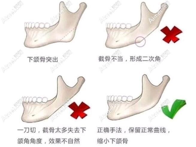 下颌角整形手术技术aimei.com