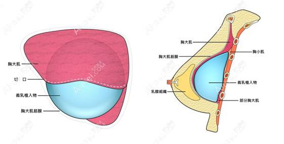 徐国建医生做隆胸手术的原理