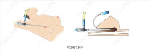 徐国建医生做内窥镜隆胸的原理