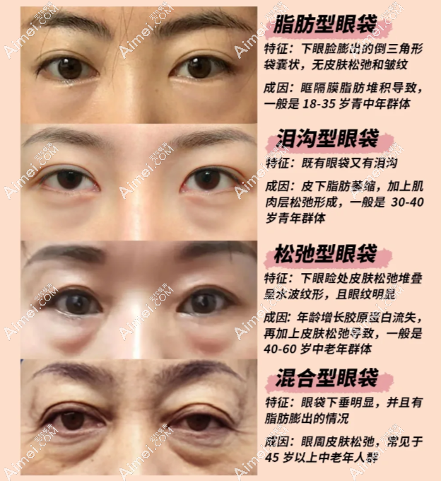 广州曙光眼袋整形腻害的医生是谁 广州曙光眼袋整形腻害的医生是谁