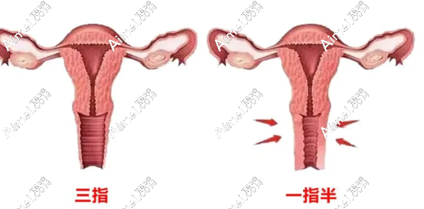 紧缩针的功效与作用:紧致阴道改善松弛,打完不会漏尿一周以上可以同房