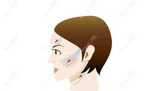成都面部筋膜提升多少钱一次？成都面部筋膜提升价格表一览（2024筋膜悬吊提升均价2.28万）