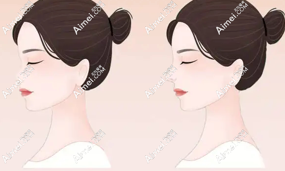   南京沈正宇专做什么项目-隆胸和鼻子,尤其是假体隆胸和鼻基底做的太惊艳  爱美网