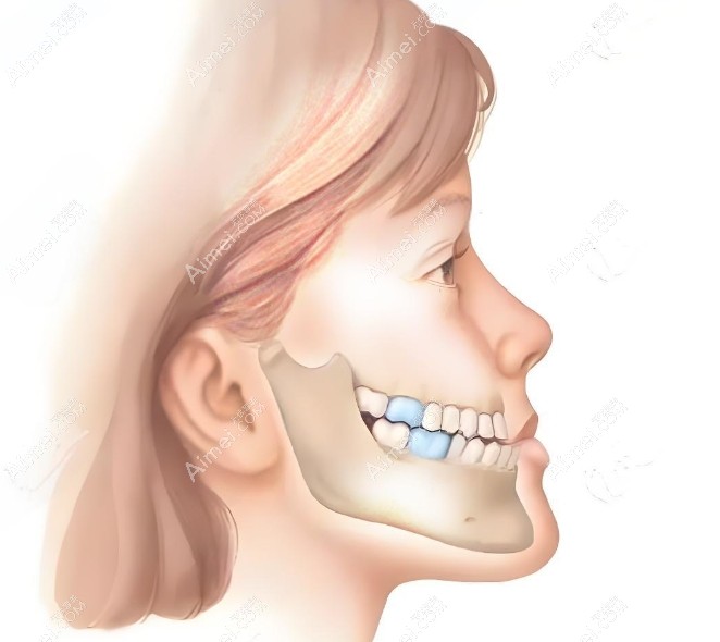 磨骨手术 磨骨手术