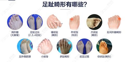 圣嘉新足雕医生靠谱