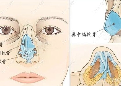鼻整形手术