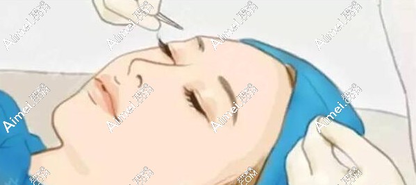 师丽丽修复内眼角实例分享(内眼角修复+眼轮匝肌对合一次修复成功) a爱美网 师丽丽修复内眼角实例分享(内眼角修复+眼轮匝肌对合一次修复成功) a爱美网