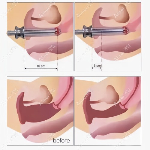南昌做激光缩阴的技术原理 南昌做激光缩阴的技术原理