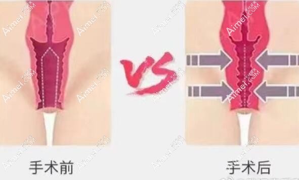 2025年东莞市做阴道紧缩术收费明细一览