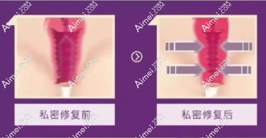打紧缩针和做紧缩手术