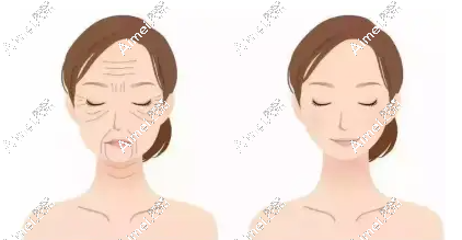李晓东面部提升手术不是拉皮!与传统拉皮手术完全不同,使用的是pst面部手术方式