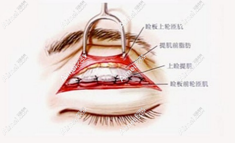 aimei.com双眼皮修复手术