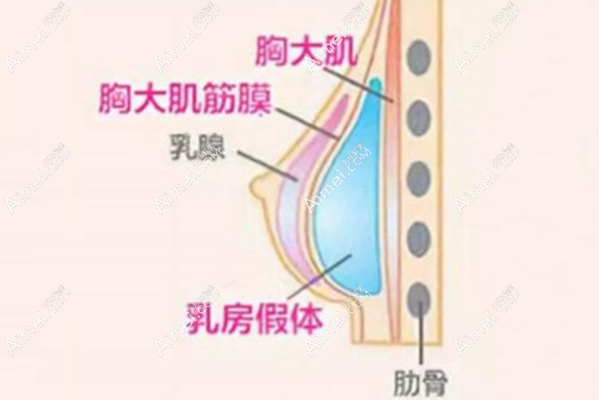 假体隆胸aimei.com 假体隆胸aimei.com