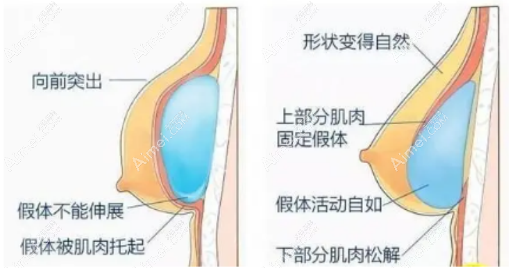 假体隆胸 假体隆胸