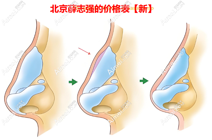北京薛志强的价格表2024,含人中/鼻子/馒化修复/溶脂/双眼皮/眼修复费用