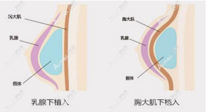 美国梦萦假体隆胸价格是10-15万元起和优缺点是成正比的