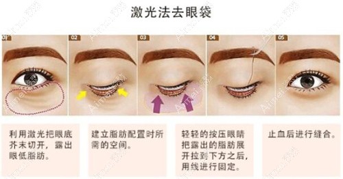 贵州割眼袋好的医院手术原理