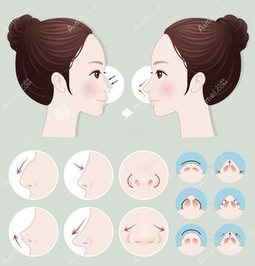 深圳李信锋鼻整形医院收费标准 深圳李信锋鼻整形医院收费标准