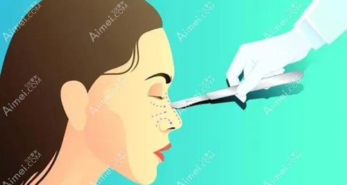 李信锋隆鼻口碑如何