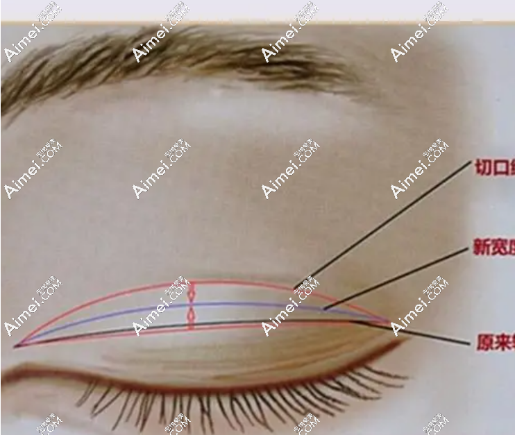 杜园园医生双眼皮修复示意图