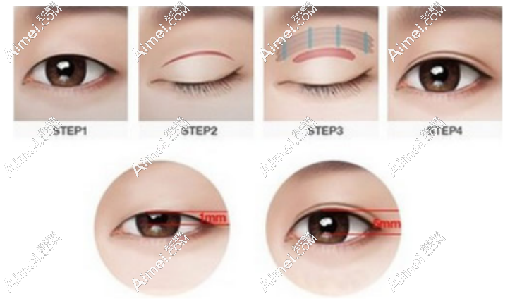 aimei.com双眼皮修复示意图