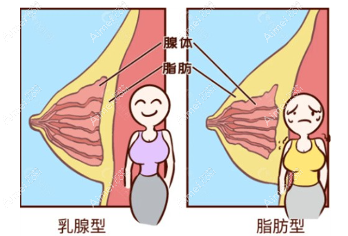 不同胸部类型