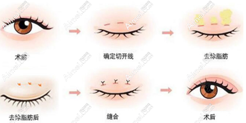 杜园园医生双眼皮修复手术