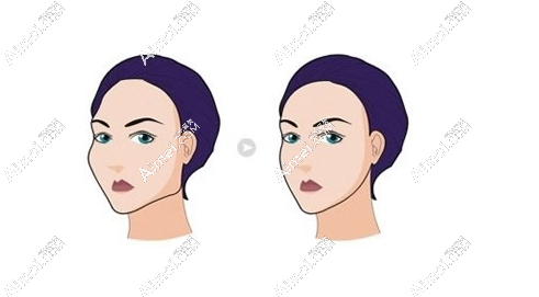 李运峰磨骨三件套多少钱-(新版价格表出炉)颧骨内推+下颌角削骨+下巴手术8万元起  爱美网