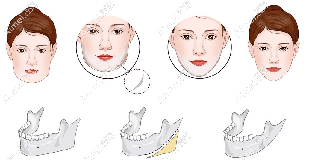 李运峰磨骨三件套多少钱-(新版价格表出炉)颧骨内推+下颌角削骨+下巴手术8万元起