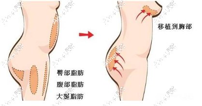 aimei.com脂肪丰胸 aimei.com脂肪丰胸