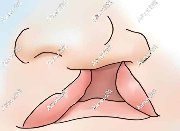 郑永生唇裂修复实例