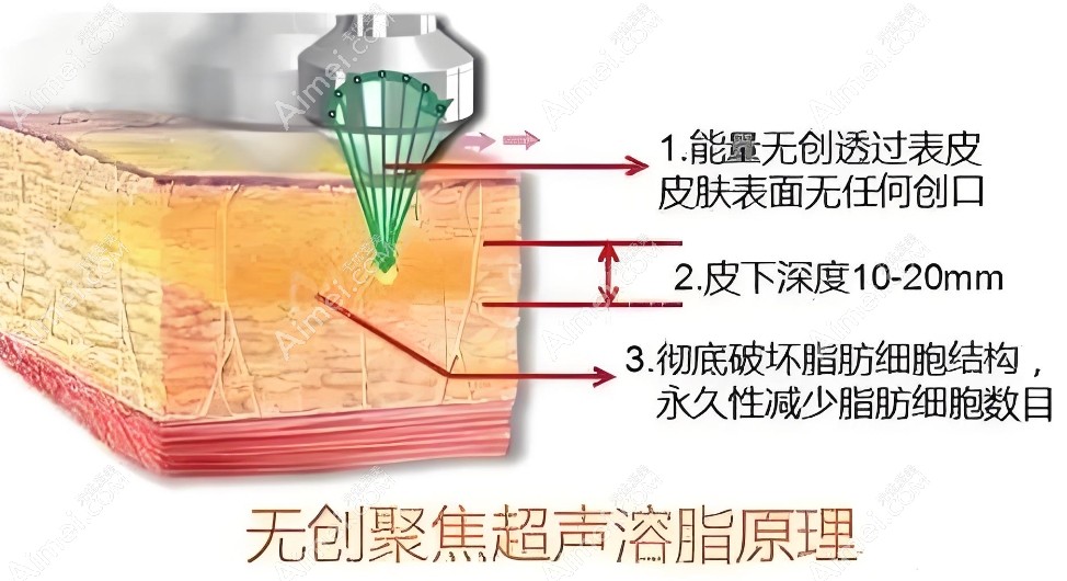 北京孙波舒适吸脂价格收费www.aimei.com