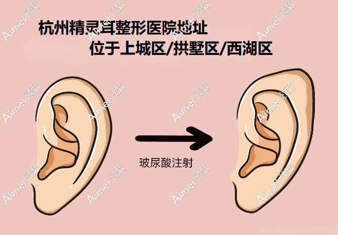 杭州精灵耳整形医院地址位于上城区/拱墅区/西湖区,排名头一浮想国收费2w人气高