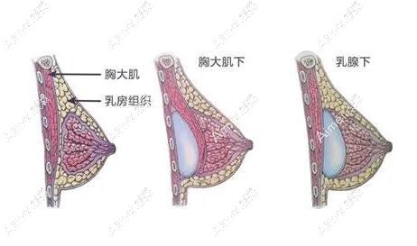 徐国建IMF舒适丰胸