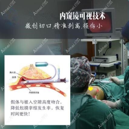 徐国建医生的隆胸技术优势