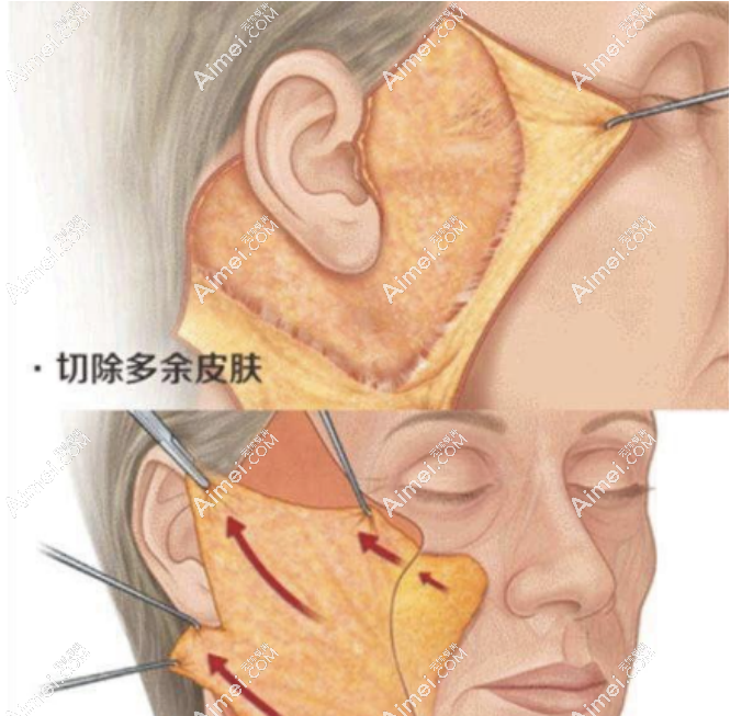 拉皮示意图