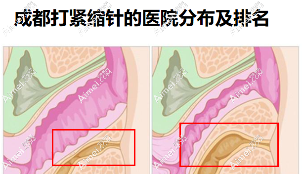 成都哪里可以打紧缩针的医院?成都市武侯区/青羊区的6家医院都能打,均价4k
