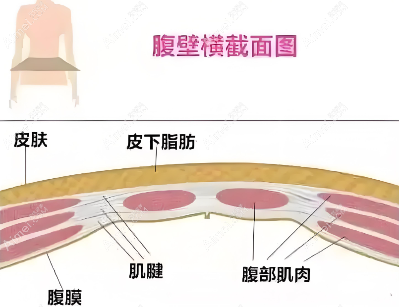 腹壁整形術(shù)
