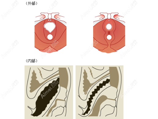 阴道紧缩治疗www.aimei.com 阴道紧缩治疗www.aimei.com